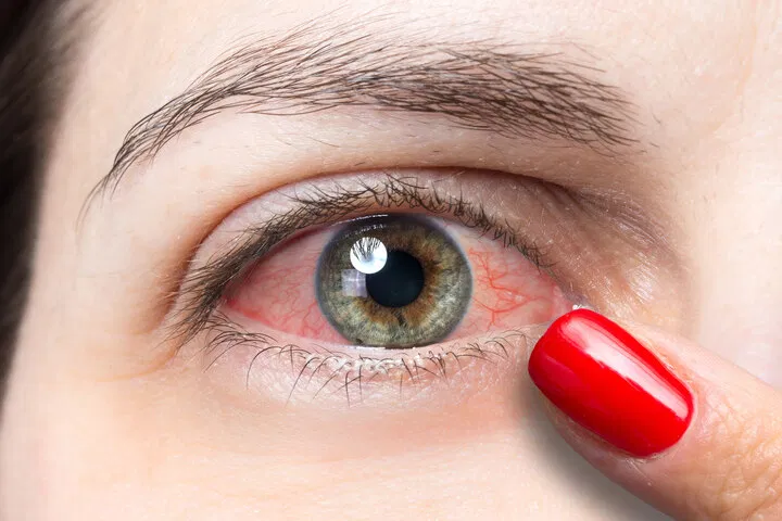smoking cannabis can cause dry or red eyes
