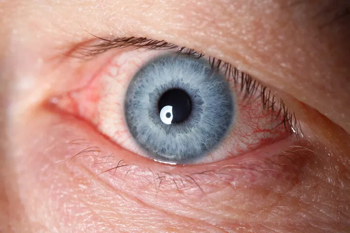 red eyes high on weed